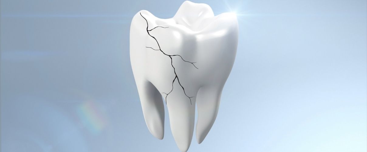 fisura dental que es y tratamiento clinica ilzarbe